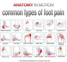 Foot Pain Chart, K Tape, Foot Exercises, Ankle Pain, Foot Pain Relief, Back Pain Remedies, Preventative Health, Hip Pain, Heel Pain