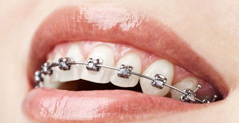 Clove Dental, Damon Braces, Types Of Braces, Orthodontics Braces, Dental Braces, Metal Braces, Teeth Braces, Dental Bridge, Dental Crowns