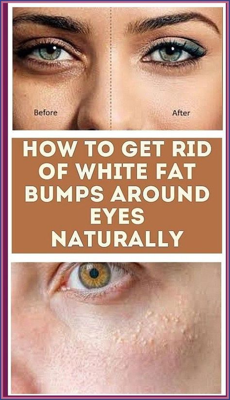 How To Get Rid of White Fat Bumps Around Eyes Naturally Bumps Under Eyes, Blind Pimple, Pimples Under The Skin, Under Eyes, Skin Care Treatments, Skin Problems, Bump, Beauty Skin, Natural Remedies