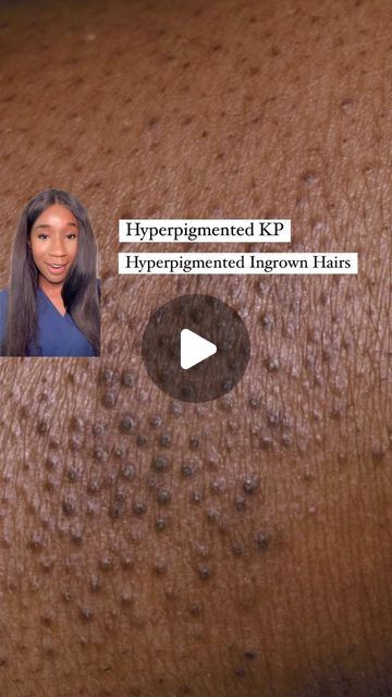 Dr Kemi Fabusiwa on Instagram: "Hyperpigmentation left behind by KP and ingrown hairs?? You DON’T have to settle for that uneven skin tone. ✨💖✨

Here’s my little recipe for smoother, more even-toned skin:

1️⃣ Exfoliate: Salicylic acid is your BFF here! It gently sloughs off dead skin cells, unclogs pores, and helps fade those pesky dark spots.

2️⃣ Brighten & Moisturize: A glycolic acid product with shea butter is the dream team! It exfoliates deeper to reveal brighter, smoother skin while the shea butter keeps your skin hydrated and happy. 🧈💖

3️⃣ Renew: A retinoid body moisturizer is a game-changer! It speeds up cell turnover, fading dark spots and preventing new ones from forming. But start slow and wear your SPF, okay? 🧴💖

#skincare #KP #hyperpigmentation #melaninskin #skincarero Dark Spots On Legs Remove, Glass Body Skin, Face Discoloration, Body Hyperpigmentation, Hyperpigmentation Black Skin, Best Body Moisturizer, Melanin Skin, The Dream Team, Body Therapy