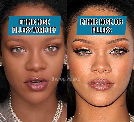 Beyonce Nose Job, Ethnic Nose Job, Nose Filler, Drake Nicki Minaj, Ethnic Nose, Beyonce Jay Z, Nose Fillers, Jay Z Kanye West, Workout Squats