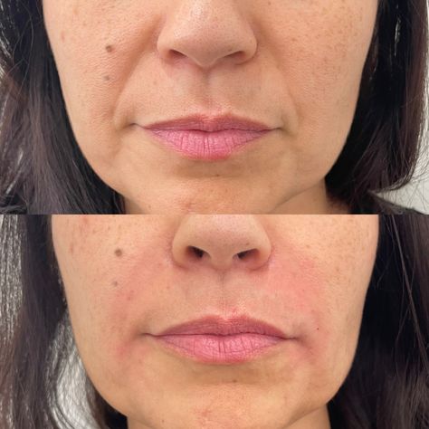 Filler Boosts 29 Facial Harmonization Before And After, Fillers Before And After, Vogue Pictures, Pdo Thread Lift, Shea Butter Benefits, Prp Hair, Skin Booster, Cheek Fillers, Thread Lift