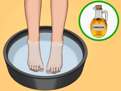 7 Ways to Treat Cracked Heels Healing Cracked Heels, How To Heal Cracked Heels, Cracked Heel Remedy, Cracked Heels Diy, Heel Fissures, Sore Heels, Heal Cracked Heels, Cracked Heel Remedies, Dry Cracked Heels