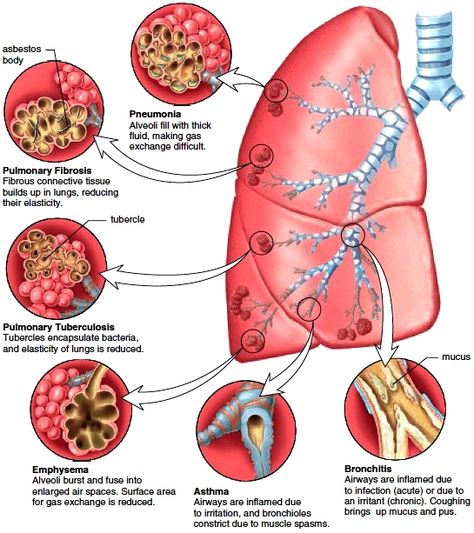 Restrictive Lung Disease | Figure 14.10 Common bronchial and pulmonary diseases. Exposure to ... Family Nurse Practitioner, Pulmonology, Respiratory Care, Nursing School Survival, Respiratory Therapy, Nursing School Studying, Medical School Studying, Nursing School Notes, Human Anatomy And Physiology