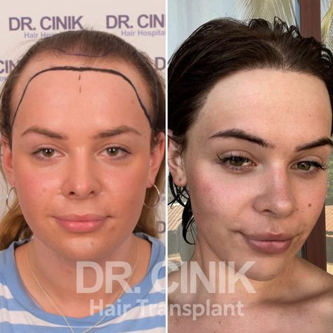 Hair Transplant for Women in Turkey: Cost, Procedures, Results | Dr Cinik Female Hair Transplant, Hair Medicine, Hair Transplant Women, Beard Transplant, Forehead Hair, Prp Hair, Androgenetic Alopecia, Fue Hair Transplant, Hair Therapy