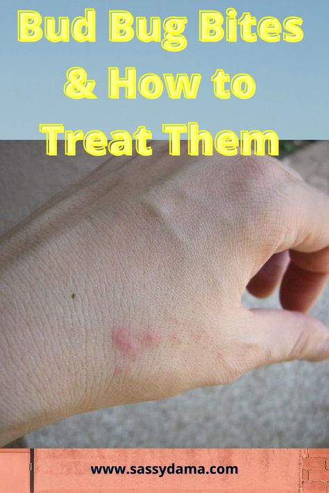 Bed bug bites can be very itchy. and if you scratch the bite sites, they can become infected. Here are ways you can identify, prevent, and control bed bugs. Red Bug Bites, Bed Bug Bites Remedies, Bed Bug Bites Pictures, Bed Bug Remedies, Bug Bites Remedies, Bug Bite Relief, Get Rid Of Bed Bugs, Bed Bug Spray, Bug Spray Recipe