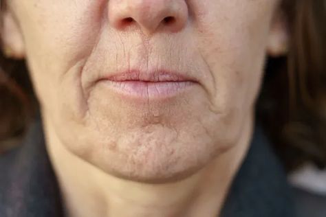 Ever caught yourself looking in the mirror and thinking your jawline doesn't look the same as it used to? You're not alone. As we age, the jawline is one of those subtle yet significant areas that undergo transformations, often making us look older than we feel. The once sharp and well-defined angles may start to blur, replaced by fine lines and sagging skin known as jowls. Jowls Sagging, Saggy Jowls, Reduce Forehead Wrinkles, Chin Wrinkles, Looking In The Mirror, Forehead Wrinkles, You're Not Alone, Anti Aging Tips, Look Older