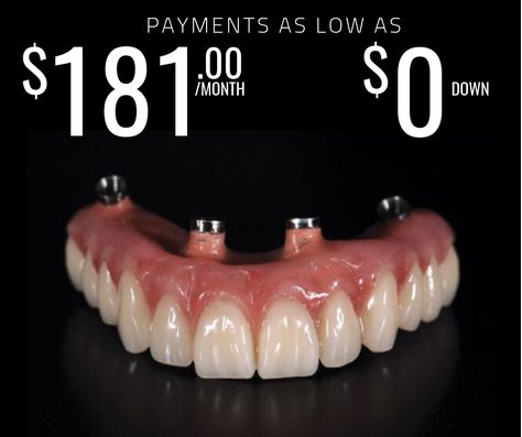 Cheap Dentures, Permanent Dentures, Headband Braids, Teeth Replacement, Free Dental Implants, Affordable Dentures, Lehi Utah, Denture Implants, Denture Adhesive