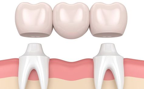 Tooth Bridge, Cantilever Bridge, Missing Tooth, Discolored Teeth, Tooth Replacement, Dental Laboratory, Restorative Dentistry, Missing Teeth, Dental Bridge