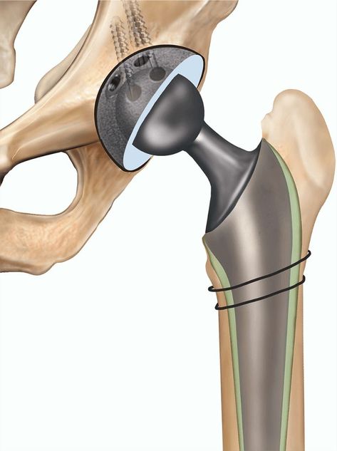 Revision Hip Replacement in West Delhi Hip Surgery, Body Joints, Wound Care, Hip Pain, Virginia Beach Va, Muscle Pain, Medical Prescription, Knee Pain, Virginia Beach