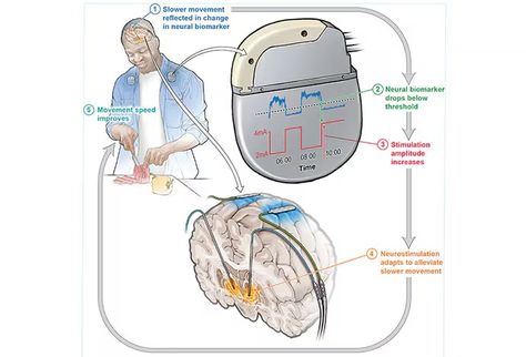 Adaptive Brain Stimulation a 'Game Changer' for Parkinson's? Pilot Study, Deep Brain Stimulation, Pathology Lab, Brain Stimulation, Family Medicine, Medical News, Aids Hiv, Internal Medicine, Brain Activities