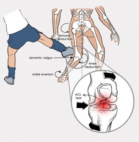 ACL injury Acl Injury, Anterior Cruciate Ligament, Ligament Injury, Cruciate Ligament, Short Workouts, Lower Limb, Braces, Medical, Humanoid Sketch