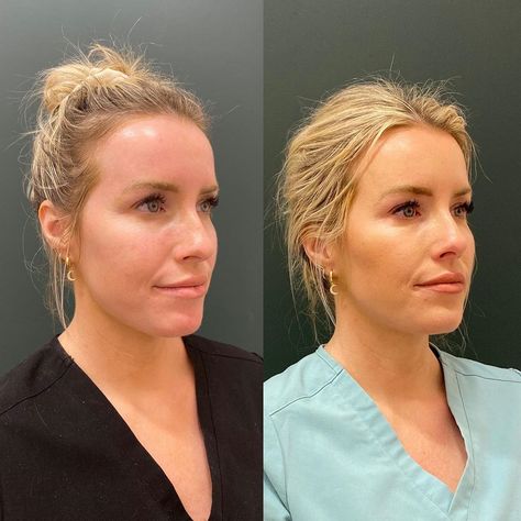 Annie Bruno Thurston| RN, CANS on Instagram: “💉✨ Using dermal fillers and botox cosmetic to create facial balancing and overall harmonization to this gorgeous babe’s face. Photos taken…” Facial Balancing Filler, Facial Balancing, Botox Cosmetic, Dermal Fillers, Beauty Body, Skin Treatments, Overalls, Facial, Skin