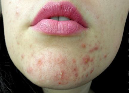 Managing and treating chin acne including cystic chin acne is hectic and tricky.... ,  #acne #Chin #Cystic #hectic #including #Managing #treating #tricky Check more at https://mitesser.naa7.com/managing-and-treating-chin-acne-including-cystic-chin-acne-is-hectic-and-tricky/ Chin Acne Remedies, Doterra Acne, Chin Acne Causes, Cystic Acne On Chin, Cheek Acne, Hormonal Acne Diet, Face Map, How To Apply Blusher, Treating Cystic Acne