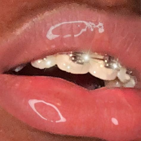 Braces And Lipgloss, Kylecore Aesthetic, Braces Aesthetic Girl, Aesthetic Braces, Braces Aesthetic, Red Braces, Cute Braces Colors, Gloss Lips, Braces Girls