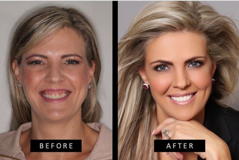 Thinc Clinic has the latest laser technology to correct a gummy smile in just one appointment Gummy Smile Correction Laser, Gummy Smile Correction, Perfect Smile Teeth, Gummy Smile, Smile Teeth, Perfect Smile, Face Skin Care, Face Skin, Surgery