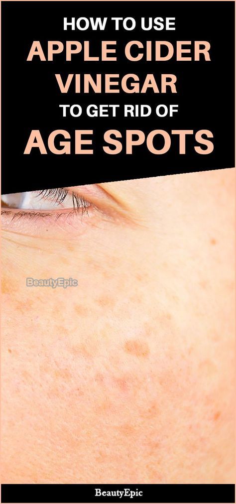 Get Rid Of Age Spots, Age Spots On Face, Age Spot Removal, Vinegar Cleaning, Spots On Face, Baking Soda Shampoo, Moisturizer For Oily Skin, How To Get Rid Of Acne, Best Anti Aging