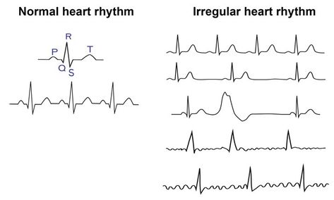 Heart Rhythm Tattoo, Rhythm Tattoo, Heart Beat Tattoo, Light Headed, Feeling Faint, Heart Rhythm, Normal Heart, Congenital Heart Defect, Heart Defect