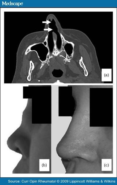 Surgical Interventions and Local Therapy for Wegener's Granulomatosis Wegeners Granulomatosis, Facial Paralysis, Paranasal Sinuses, Sinus Congestion Relief, Autoimmune Disorders, Congestion Relief, Pa School, Health Guru, Sinus Congestion