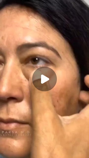 Bag Eyes How To Get Rid, How To Remove Eye Bags, How To Get Rid Of Eye Bags, How To Brighten Eyes, Puffy Bags, Puffy Eyes Remedy, Brighten Eyes, Clear Skin Routine, Face Cleaner