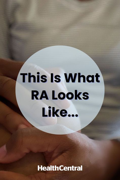 Some rheumatoid arthritis symptoms are less visible, but not less challenging. There are various ways rheumatoid arthritis can affect your body. While we asked our experts to describe theoretically how RA can look, keep in mind that with today’s medications, many people do not experience the severe deformities they might have 20 years ago. Let’s take a look at the various ways rheumatoid arthritis can affect your body. Rheumatoid Quotes, Rheumatoid Flare Up, Rheumatoid Symptoms, Rheumatoid Nodules, Ra Symptoms, Inflammation Causes, Physical Change, Periodontal Disease, Chronic Inflammation