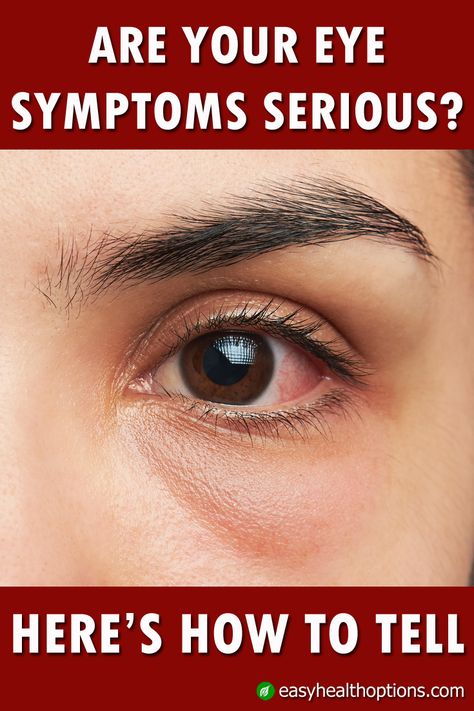 We all have times when our eyes are red, itchy or irritated. But how can you tell whether a color, swelling or other sensation is commonplace and nothing to worry about, or something you should get attention for immediately? Eye Irritation Remedies, Itchy Eyes Remedy, Red Eyes Remedy, What Causes Red Eyes, Redness Remedy, Itchy Eyelids, Swelling Remedies, Swollen Eyes, Irritated Eye