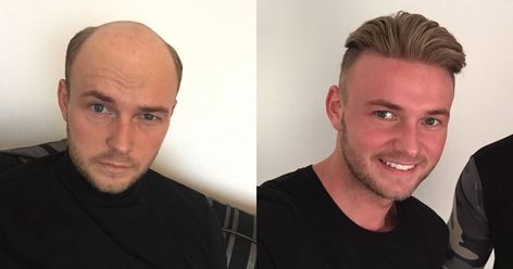 Bye bye baldness. Getting Haircut, Hair Pieces For Men, Hair Replacement For Men, Bald Guy, Mens Toupee, Hair Replacement Systems, Hair Transplant Surgery, Hair Toupee, Mens Wigs