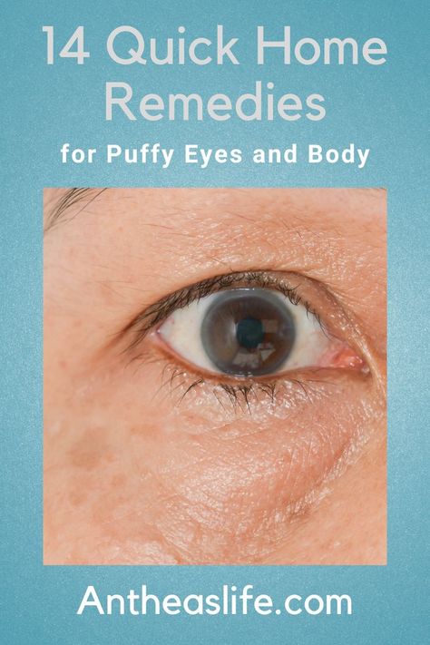 Many of us struggle frequently or occasionally with puffy feet, eyes, or faces which can be annoying. Here are 14 quick home remedies for puffy eyes and body. #healthyhabits #homeremedies #natural Puff Eyes Remedies, Puffy Eyes Crying, Puffy Under Eyes, Puffy Eyes Remedy, Watery Eyes, Puffy Eyes, Healthy Habits, Home Remedies