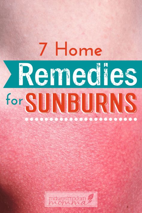 7 Home Remedies For Sunburns Sunburn Blisters, Remedies For Sunburn, Home Remedies For Sunburn, Get Rid Of Sunburn, Severe Sunburn, Sunburn Peeling, Natural Remedies For Sunburn, Bad Sunburn, Sunburn Remedies