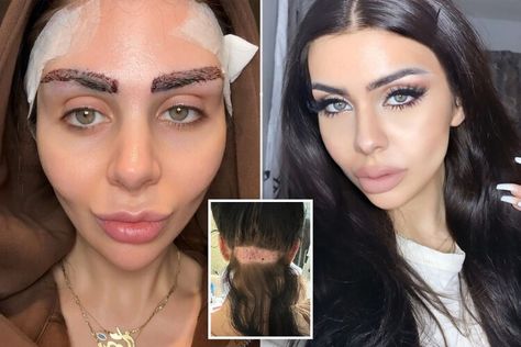 I overplucked my eyebrows as a teen — so I got a $5K transplant that makes me feel younger — New York Post Eyebrow Hair Transplant, Eyebrow Transplant, Perfect Eyebrow Shape, Facial Fillers, How To Grow Eyebrows, Thick Eyebrows, Perfect Eyebrows, Feel Younger, Eyebrow Shape