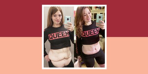 Lexi Reed Says Her Skin-Removal Surgery Results Are ‘Amazing And Surreal’ 2 Months Later Skin Removal Surgery, Protein Veggies, Seven Pounds, More Protein, Weights Workout, 2 Months, Fitness Beauty, Stay Fit, Strength Training