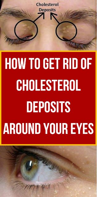 High Cholesterol Levels, Metabolic Disorders, Upper Eyelid, Organic Remedy, Ldl Cholesterol, Reduce Cholesterol, Medical Terms, Types Of Cancers, High Cholesterol