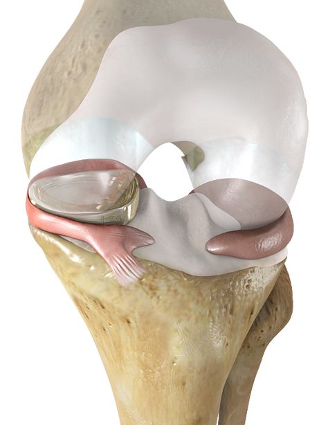 Knee implant may return millions of Americans to active lifestyle - Story Studio – MySanAntonio.com Meniscus Surgery, Meniscal Tear, Core Exercises For Women, Swollen Knee, Knee Strengthening Exercises, Knee Replacement Surgery, Knee Exercises, Knee Pain Relief, Knee Surgery