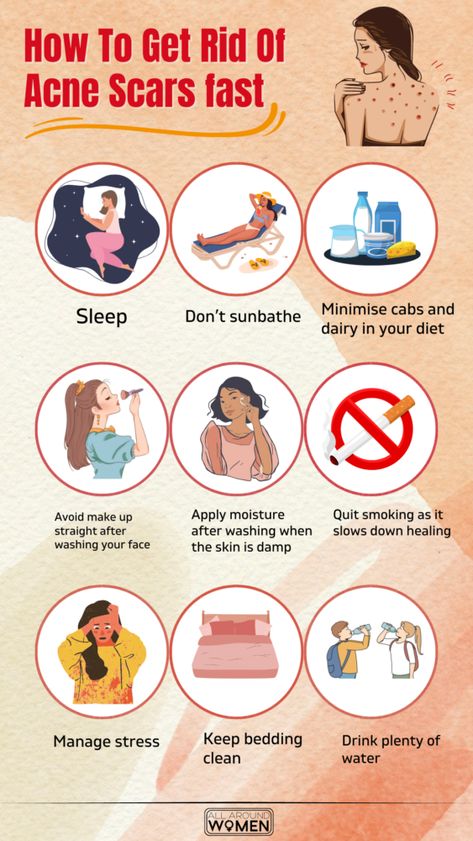 How To Get Rid Of Acne Scars Fast🌸 #acne #pimples #pimplesremedies #acneremedies #skincarediy. https://whispers-in-the-wind.com/combatting-pimples-under-the-skin-expert-tips-and-product-recommendations/?105 Getting Rid Of Scars, Face Mapping Acne, Blind Pimple, Stubborn Acne, Pimples Under The Skin, Acne Prone Skin Care, Pimples Overnight, Get Rid Of Acne, Rid Of Acne