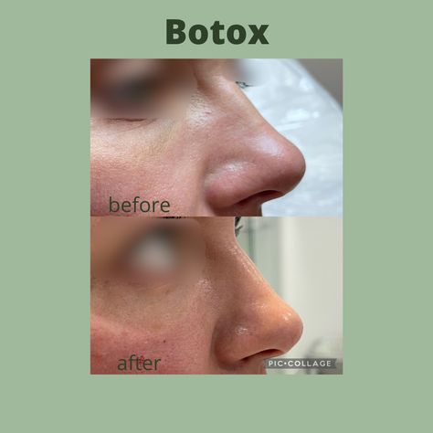 Natural enhancement on the nose with botox Tinkerbell Nose, Botox Nose, Nose Lift, Face Laser, Botox Before And After, Face Lift Surgery, Botox Face, Aesthetic Doctor, Thread Lift