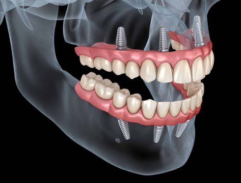 Losing a tooth is a hard experience; losing more than one is far worse. It’s... Prosthetic Teeth, Dental Studio, Dental Images, Bone Grafting, Dental Implant Surgery, Dental Implants Cost, What Can I Eat, Dental Design, Dental Marketing