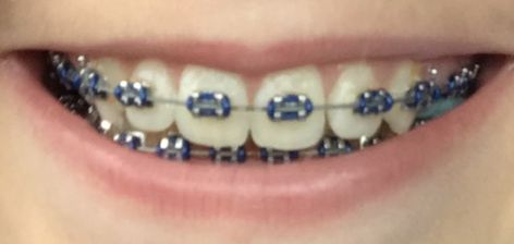 Navy Blue Power Chain Braces, Blue Braces Aesthetic, Navy Blue Braces Teeth, Dark Green Braces, Royal Blue Braces, Braces Navy Blue, Dark Blue Braces, Burgundy Braces, Navy Blue Braces