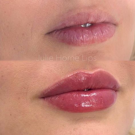 Best of Cosmetic Dermatology on Instagram: “Natural pout and crisp border with 1 ml Restylane Kysse 💉💋 Thoughts? . . Impressive work by @juliehornelips 🙌🙌 . . #Filler #fillers…” 1ml Of Lip Filler, Lip Filler 5ml, 1.5 Lip Filler, Vermillion Border Lip Filler, Lip Filler Natural Look, Lip Filler 1 Ml, Lip Filler Before And After 1ml, Pout Lip Filler, Natural Lip Fillers 1ml