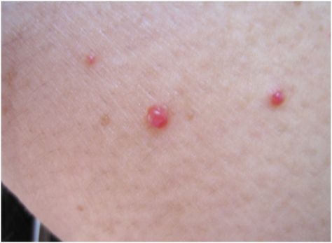 Should You Worry if Your Skin Has Little Red Bumps Like This One on It? Red Bumps On Face, Red Skin Spots, Cherry Angioma, Red Moles, Fruit Recipes Healthy, Human Body Temperature, Skin Bumps, Health Guru, Skin Spots