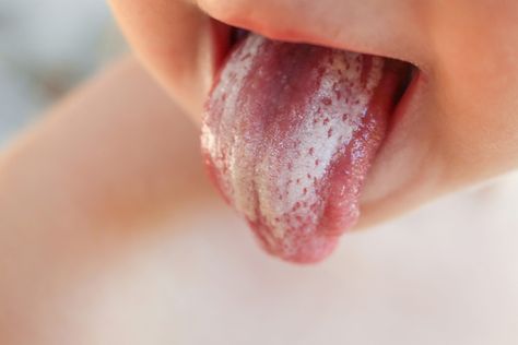 Systemic Diseases: Oral Signs to Watch for in Dental Patients - Today's RDH Asthma Spray, Candida Supplements, Candida Yeast Infection, Yeast Infection Symptoms, Kedokteran Gigi, Candida Overgrowth, Candida Yeast, Candida Albicans, Candida Diet