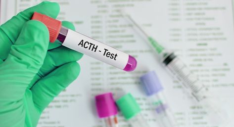 Why is this test performed?

This hormone test is evaluated in different conditions, such as Adrenal insufficiency, in Acromegaly and Cushing Syndrome.
In Addison's disease, the level of Adrenocorticotropic hormone (ACTH) is noted more than 1000 pg/ml.
In Adrenal carcinoma, Adenoma, and Adrenocortical insufficiency, the level of Adrenocorticotropic hormone (ACTH) decreases.

Collection of Sample
For the estimation of Adrenocorticotropic hormone (ACTH), patient’s plasma is needed. Blood is c Low Ferritin, Cholesterol Test, Thyroid Test, Medical Journal, Penyakit Jantung, دورة شهرية, Hashimotos Disease, Allergy Testing, Uric Acid