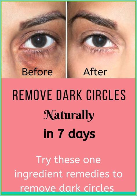 Under Eye Dark Circles, Eye Dark Circles, Healthy Heart Tips, Cleaning Your Ears, Chest Congestion, Health Signs, Remove Dark Circles, Under Eyes, Dark Circles Under Eyes