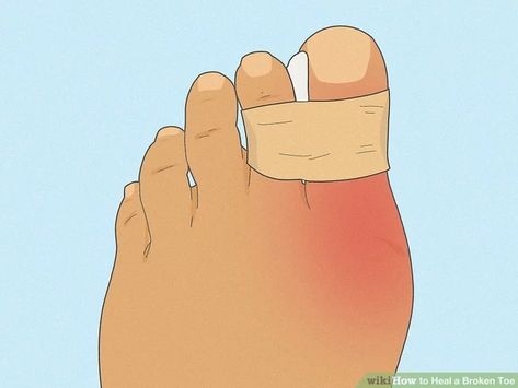 How to Heal a Broken Toe: 13 Steps (with Pictures) - wikiHow Reduce Bruising, Small Bones, Hairline Fracture, Broken Foot, Diy Beauty Treatments, Diy Wrap, Broken Leg, Emergency Room, Backpacking