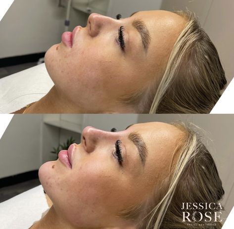 Natural Cheek Filler, Face Fillers Before And After Jaw, Nose Botox Before And After, Nose Filler Before After, Facial Balancing Before And After, Face Fillers Before And After, Nose Job Inspiration Natural, Jawline Fillers Before And After, Cheek Fillers Before And After Face