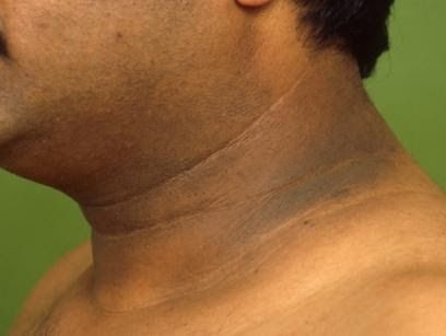 Common Skin Pigmentation Disorder: Acanthosis nigricans Spring Texas | Houston Dark Patches On Skin, Skin Care Procedures, Acanthosis Nigricans, Skin Lightener, Internet Logo, Texas Houston, Spring Texas, Advanced Skin Care, Skin Pigmentation