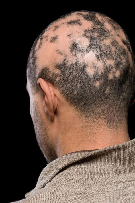 Alopecia universalis (AU) is a rare and severe type of alopecia areata. While alopecia areata is primarily known for causing round, sporadic patches of hair loss on the head, AU causes complete hair loss on both the scalp and the entire rest of the body Hairstyle Man, Alopecia Universalis, Alopecia Hairstyles, Dermatologist Recommended, Hair Follicle, Dermatology, Self Care Routine, Grow Hair, Fitness Diet