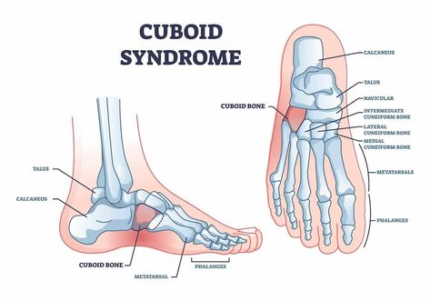 Are you experiencing pain on the side of your foot? It might be cuboid syndrome, a condition affecting a small bone in your foot called the cuboid. This pain can make walking or standing uncomfortable Cuboid Syndrome, Peroneus Longus, Twisted Ankle, Sprained Ankle, Free Movement, Bones And Muscles, Best Exercises, Strong Muscles, Pain Relief