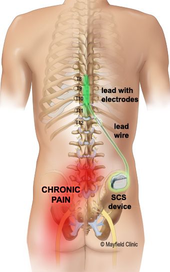 Spinal Degeneration, Spinal Cord Stimulator, Spine Problems, Spinal Fusion, Spinal Nerve, Human Body Anatomy, Lower Extremity, Spine Health, Nerve Pain Relief