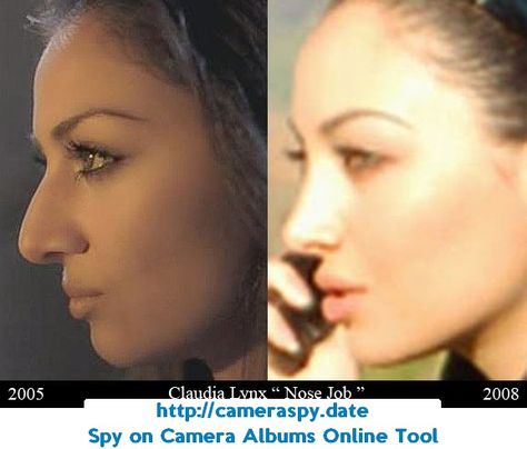 persian nose jobs before and after - Google Search Persian Nose, Nose Plastic Surgery, Nose Surgery Rhinoplasty, Nose Jobs, Rhinoplasty Nose Jobs, Job Inspiration, Perfect Nose, Nose Surgery, Search Google