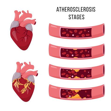 Disease Infographic, Heart Arteries, Science Diagrams, Human Heart Anatomy, Types Of Humans, Cardiac Disease, Heart Anatomy, Work Images, Future Career